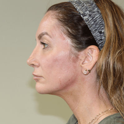 Treatment sample