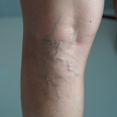 Varicose Veins