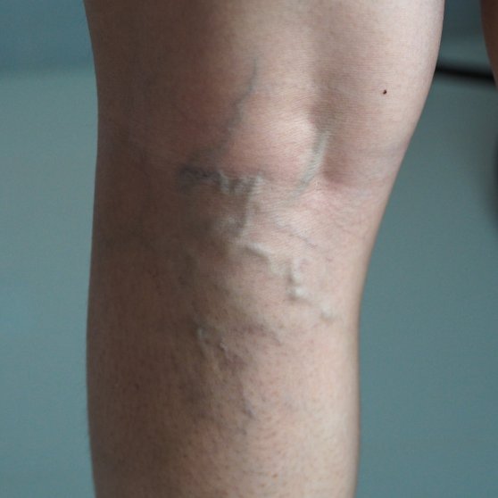 Varicose Veins